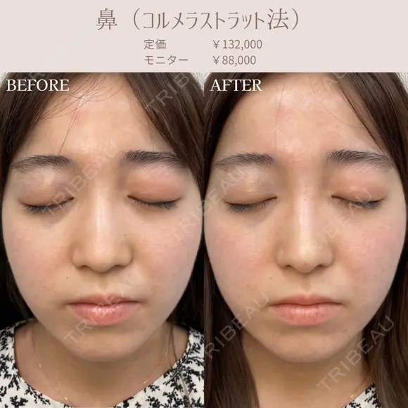 鼻先ヒアルロン酸( コルメラストラット法 ) before画像 メイン用