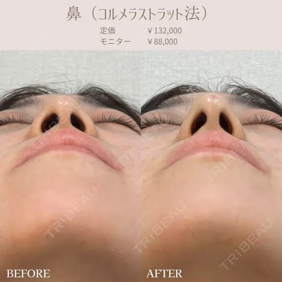 鼻先ヒアルロン酸( コルメラストラット法 ) after画像 メイン用