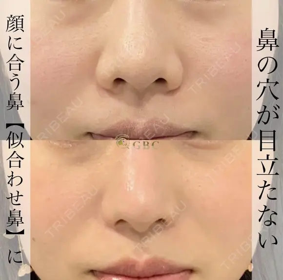 プロテーゼ＋鼻尖形成＋軟骨移植＋鼻柱下降＋鼻翼縮小 before画像 メイン用