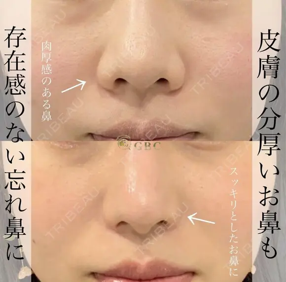 プロテーゼ＋鼻尖形成＋軟骨移植＋鼻柱下降＋鼻翼縮小 after画像 メイン用