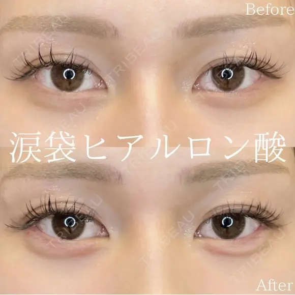 涙袋ヒアルロン酸 before画像 メイン用