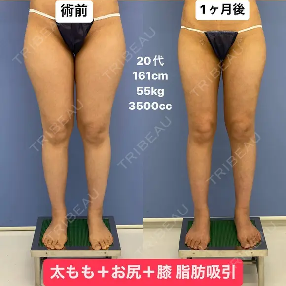 スラリとした美脚へ💃脂肪吸引 30日後 メイン用