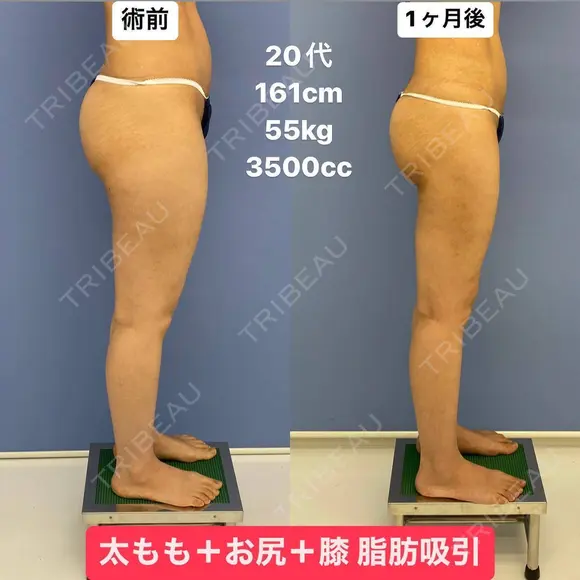 スラリとした美脚へ💃脂肪吸引 30日後 メイン用