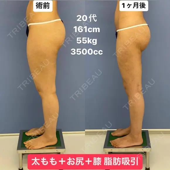 スラリとした美脚へ💃脂肪吸引 30日後 メイン用