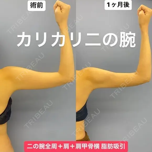 華奢な肩回りを作る💘美ボディ脂肪吸引 before画像 メイン用