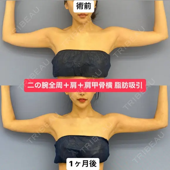 華奢な肩回りを作る💘美ボディ脂肪吸引 30日後 メイン用