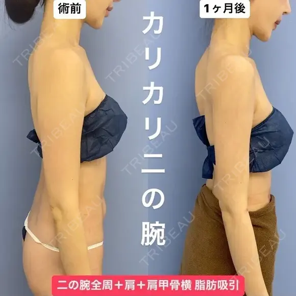 華奢な肩回りを作る💘美ボディ脂肪吸引 30日後 メイン用