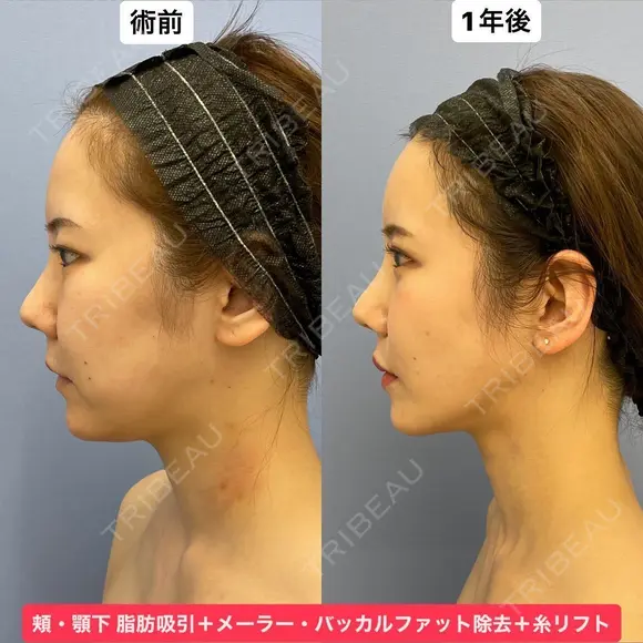 Eラインも輪郭も美しく💕 365日後 メイン用