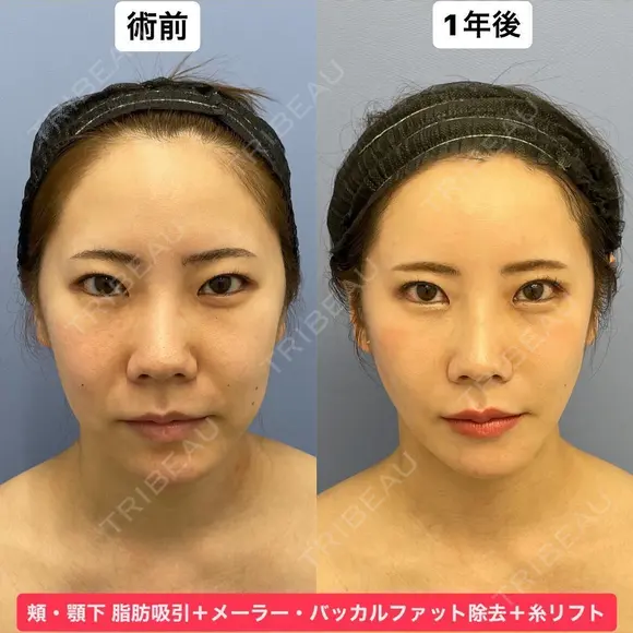 Eラインも輪郭も美しく💕 365日後 メイン用