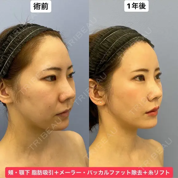 Eラインも輪郭も美しく💕 365日後 メイン用