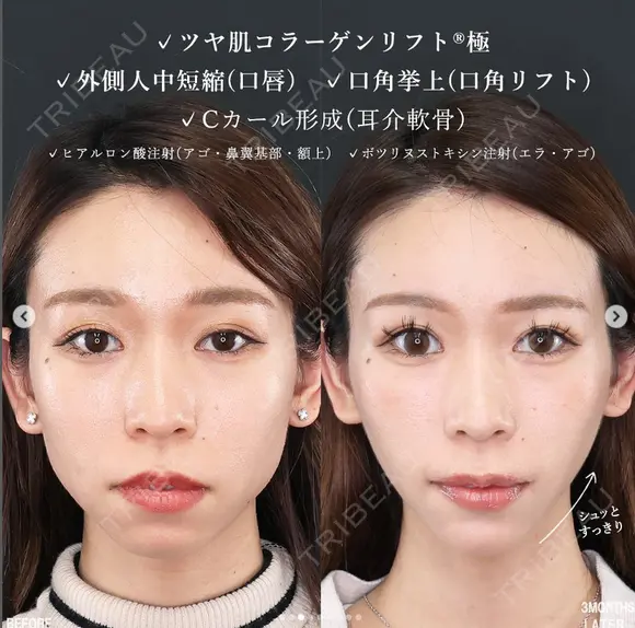【人中短縮×糸リフト】のトータルビューティー before画像 メイン用