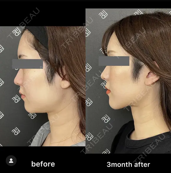 脂肪吸引注射（アゴ下） before画像 メイン用