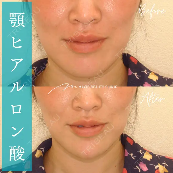 ヒアルロン酸注入（あご） before画像 メイン用