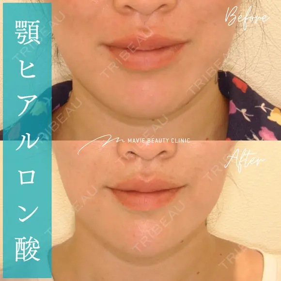 ヒアルロン酸注入（あご） 60日後 メイン用