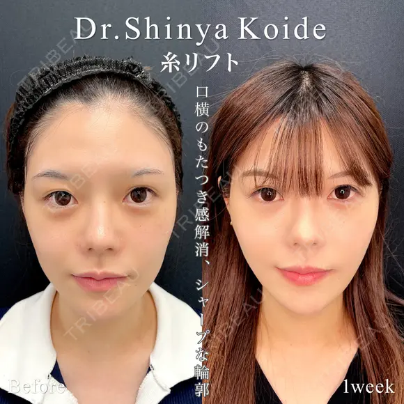 アプリリフト10本＋ヒアルロン酸(法令線) before画像 メイン用