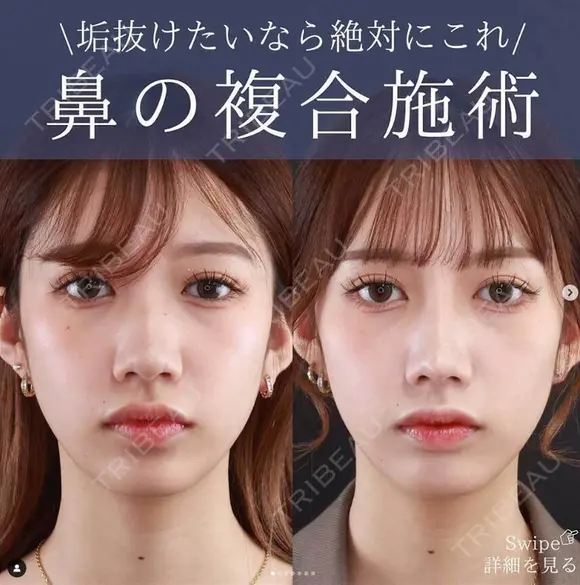 鼻尖形成＋軟骨移植＋鼻中隔延長術＋プロテーゼ before画像 メイン用