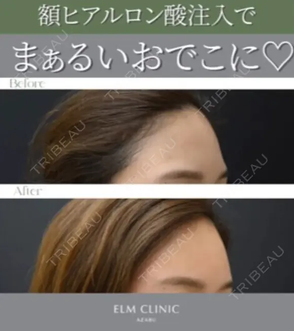 ふっくら丸いおでこ😌額ヒアルロン酸 after画像 メイン用