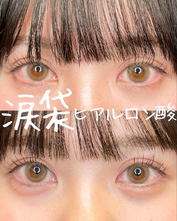 涙袋ヒアルロン酸 after画像 メイン用