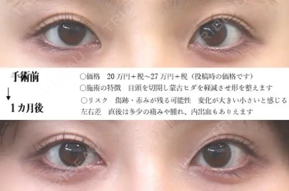 目頭切開法 30日後 メイン用