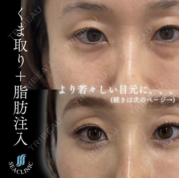 目の下のクマ取り after画像 メイン用