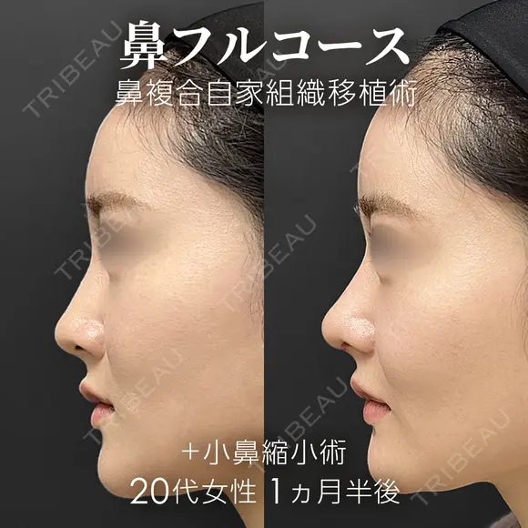 鼻フルコース（鼻複合自家組織移植術）＋小鼻縮小術 before画像 メイン用