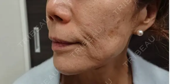 フェイスタイト before画像 メイン用