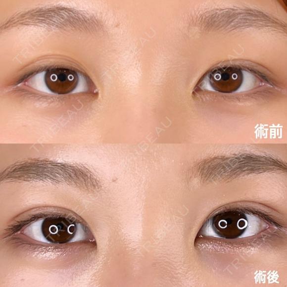 理想の二重幅に💖"腫れにくい"取れにくい"/二重埋没/線留め法 before画像 メイン用