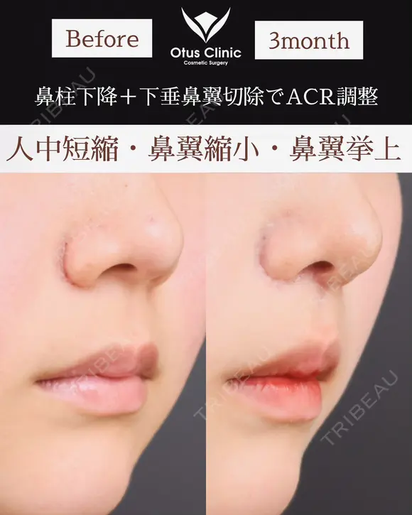 人中短縮・鼻翼縮小・鼻翼挙上 before画像 メイン用
