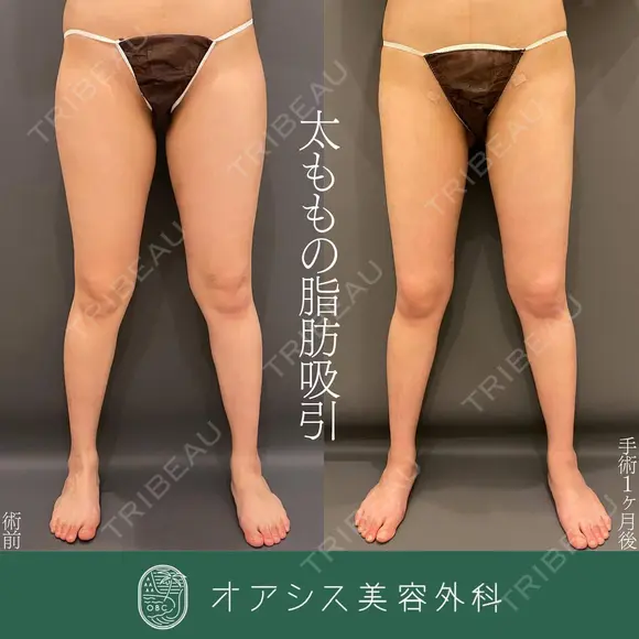 カリカリ脂肪吸引太もも3,460cc吸引 before画像 メイン用
