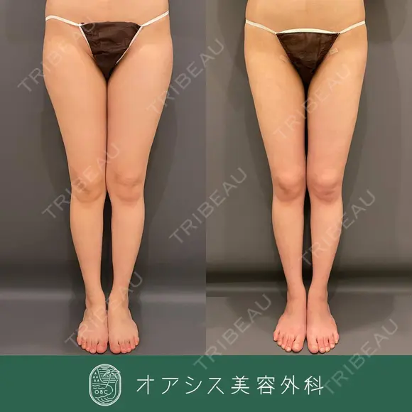カリカリ脂肪吸引太もも3,460cc吸引 after画像 メイン用