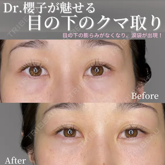 涙袋が生まれる💎目の下のくま取り before画像 メイン用