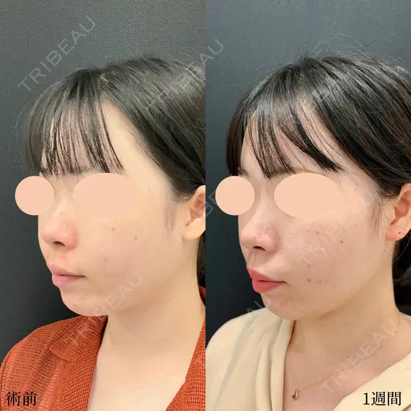小顔脂肪吸引注射(あご下) 7日後 メイン用