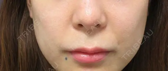TAC式 人中短縮術 before画像 メイン用