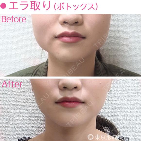 エラボトックス （小顔・歯ぎしり) after画像 メイン用