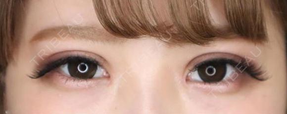 二重全切開+目頭切開⠀ ⠀ after画像 メイン用