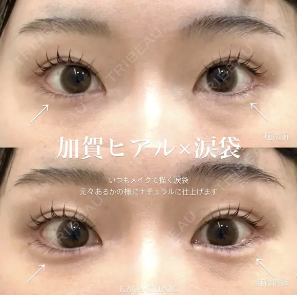 加賀デザイン＊涙袋ヒアルロン酸 before画像 メイン用