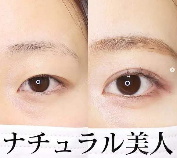 二重埋没法 after画像 メイン用