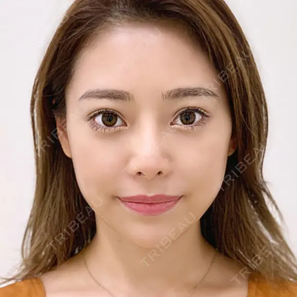 【メスを使わない小顔術】小顔Aスレッド® before画像 メイン用