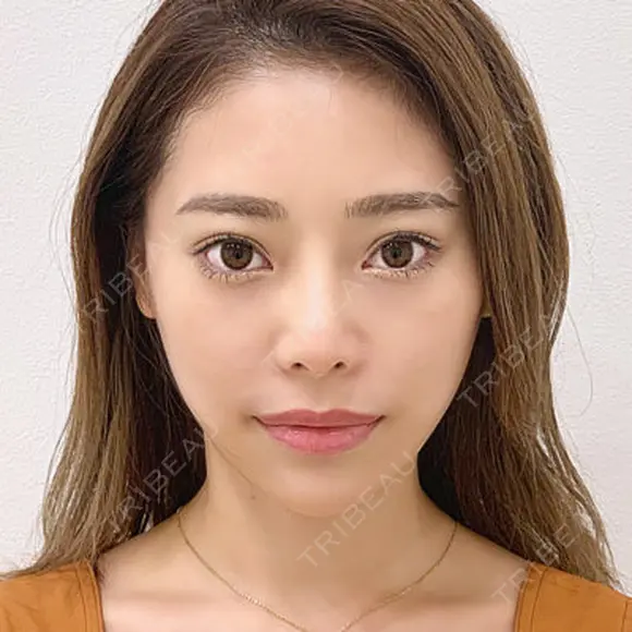 【メスを使わない小顔術】小顔Aスレッド® 0日後 メイン用