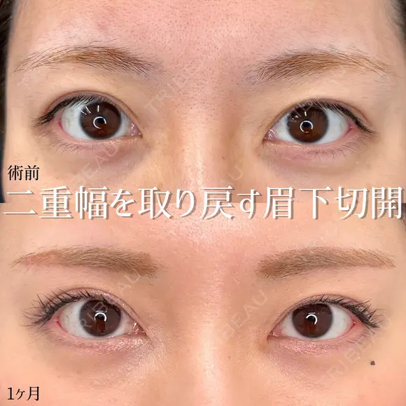 MD式眉下切開 before画像 メイン用