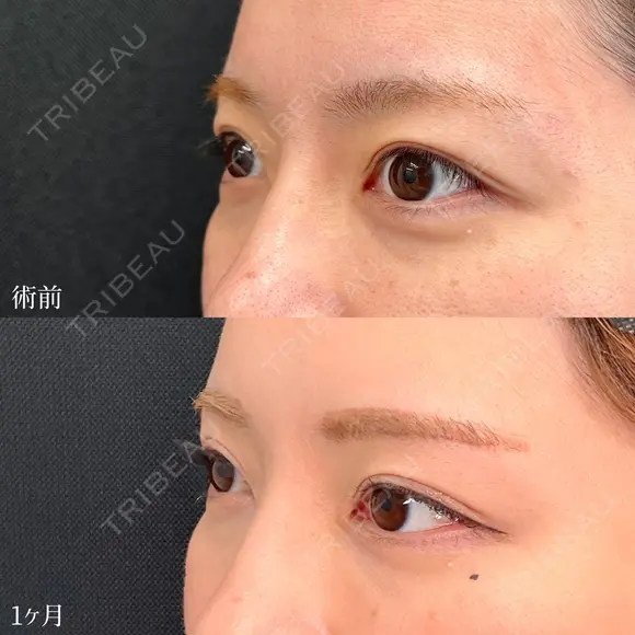 MD式眉下切開 30日後 メイン用