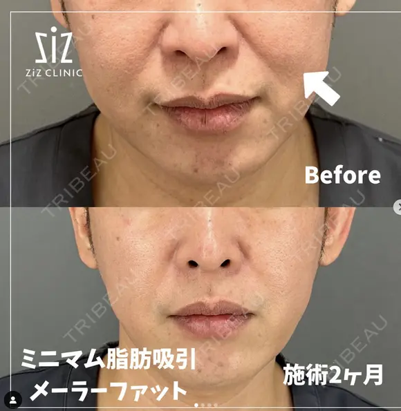 ミニマム脂肪吸引｜頬骨ダウン before画像 メイン用