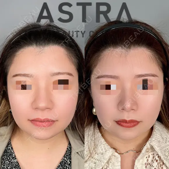 鼻尖形成 before画像 メイン用