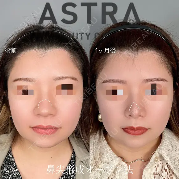 鼻尖形成 after画像 メイン用