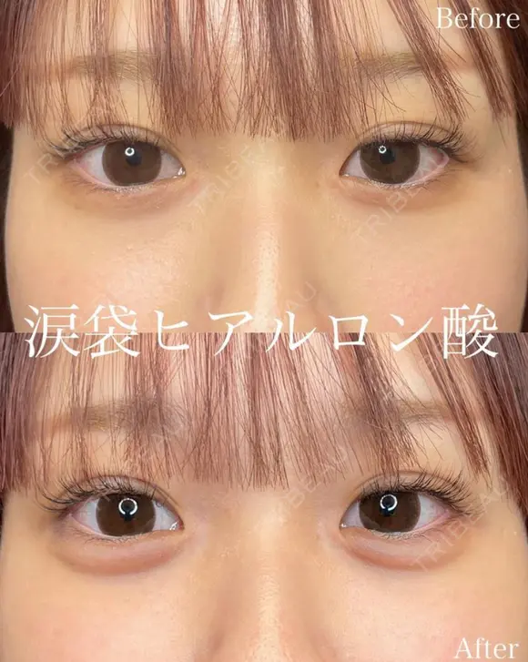涙袋ヒアルロン酸 before画像 メイン用