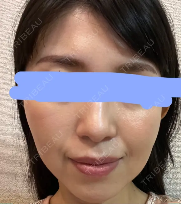 ハイフ（顔） プラチナクリニック DAY 4 メイン用