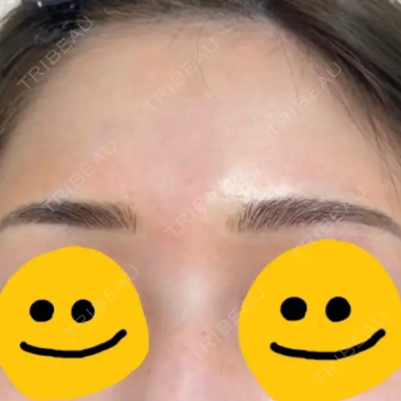 アートメイク（ほくろ） メディカルアートメイク大阪 DAY 3 メイン用