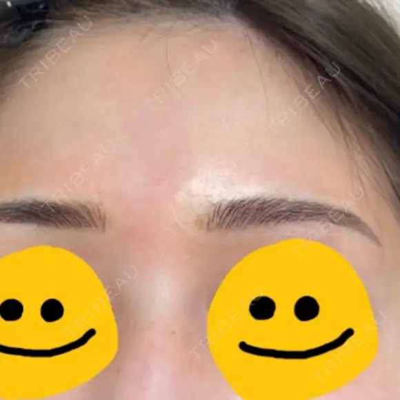 アートメイク（ほくろ） メディカルアートメイク大阪 AFTER メイン用