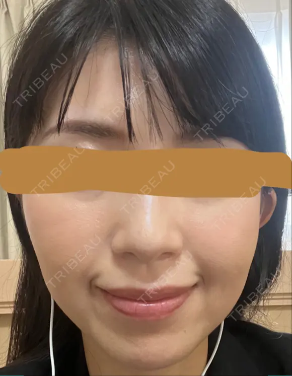 ハイフ（顔） プラチナクリニック DAY 6 メイン用