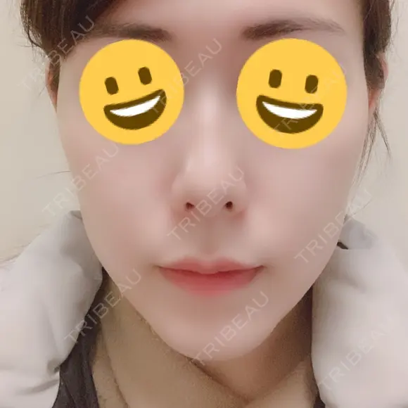 骨切り（あご） / 脂肪吸引（顔） / セットバック / ルフォー+ssro（両あご) リッツ美容外科 東京院 DAY 22 メイン用